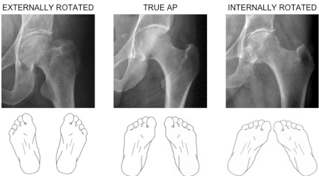 X-ray showing hips - external, true ap, internal. With images showing how foot alignment is affected.